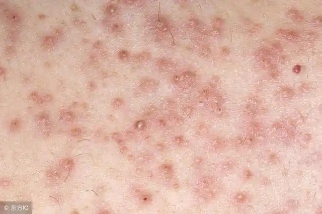 毛囊炎的症状和图片(皮囊炎的图片)-始兴思宇科技