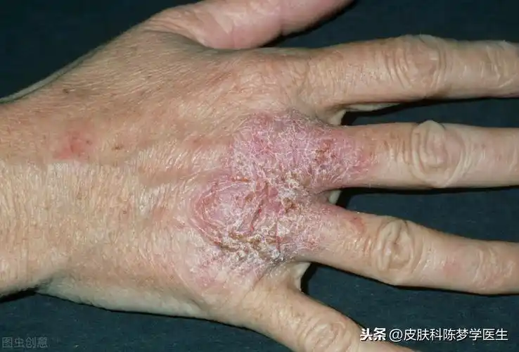 皮肤病图片及名称大全(8种常见皮肤病对应的外涂药膏) - 赤虎壹号