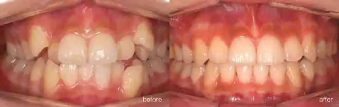 牙齿不齐,大龄女白领的烦心事