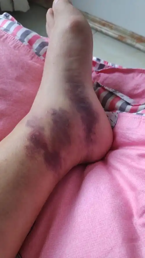 脚脖子崴了还充血了怎么办?