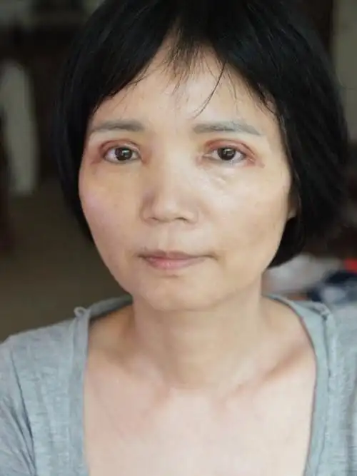 人到中年双眼皮离奇消失,眼皮下垂眼睛无神怎么破?