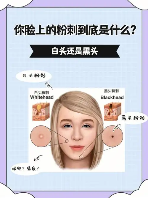 黑头和白头粉刺到底该怎么去除