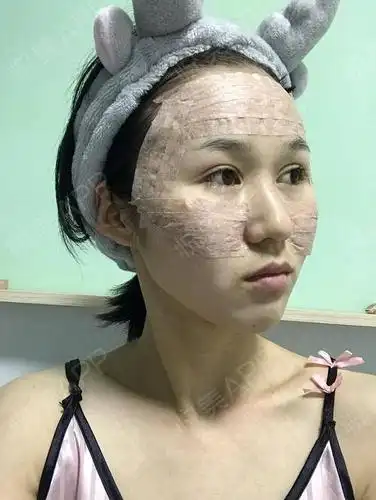 做了脂肪填充,看我术前的照片,可以明显的看出来凹陷严重,这么些年我