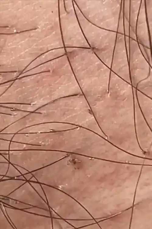 [胡瓜]将阴毛全部剃掉破坏阴虱生长的环境,使相应的症状有所减轻.