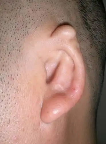 小耳畸形等级分类图片详解