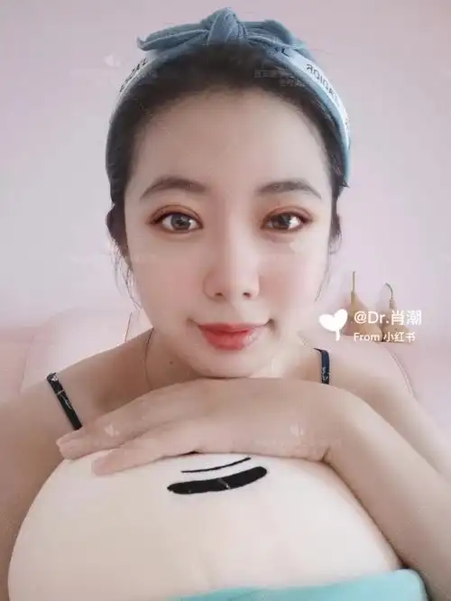 全切双眼皮77开眼角术后1个月