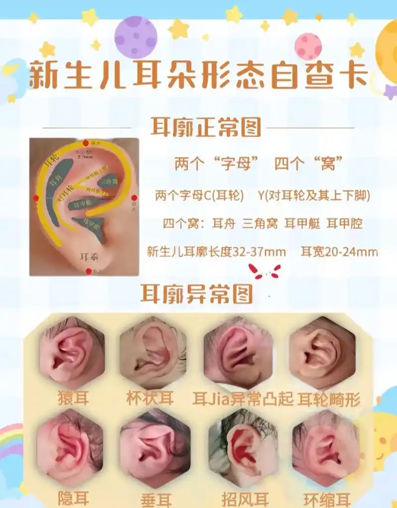 78新生儿耳廓形态畸形分类