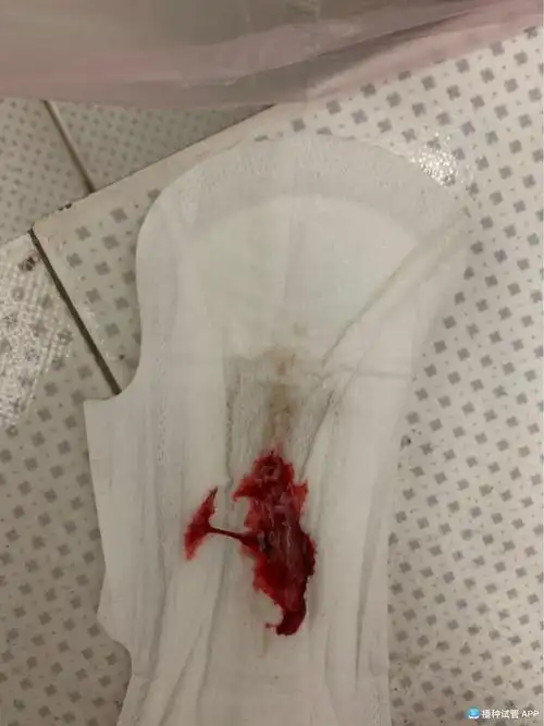 [试管婴儿]从早上出血到现在感觉跟月经一样