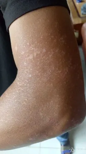 15年庆全科皮肤病看图诊疗一13多形性日光疹