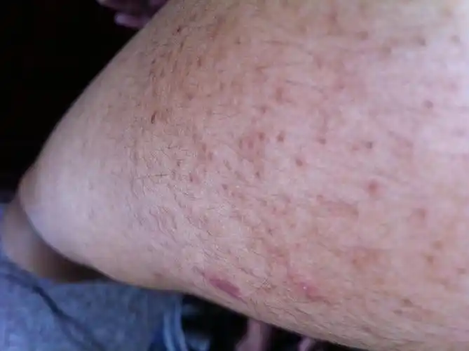 指导意见: 治疗建议,仅仅是发生在手臂部治疗很简单,你可以外用维a酸