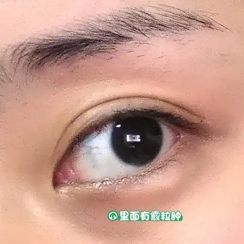 两年的霰粒肿怎么办