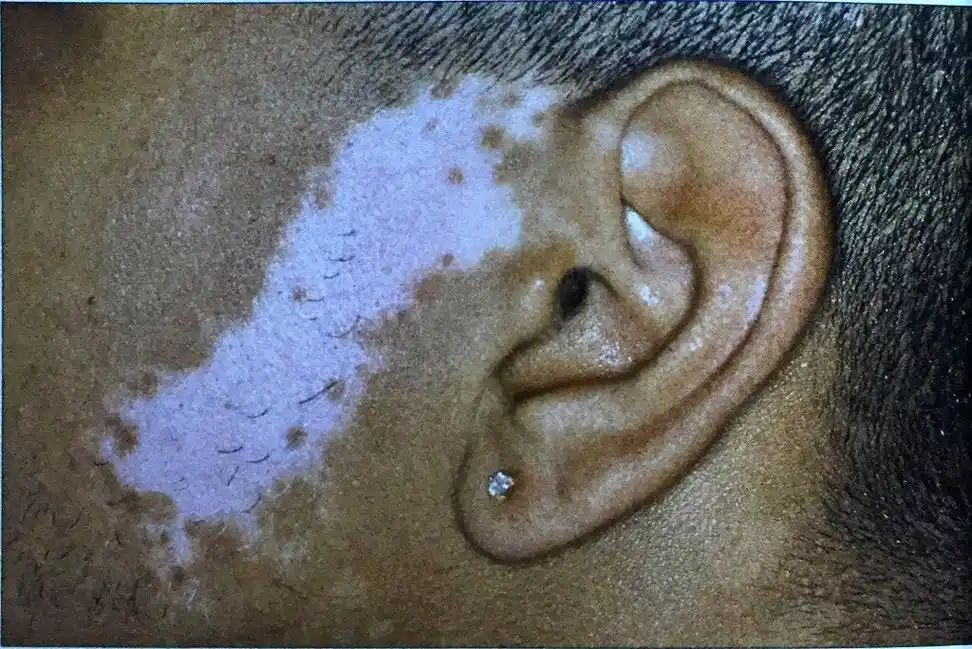 身上的这些小白点不是白癜风有可能是皮肤衰老的表现