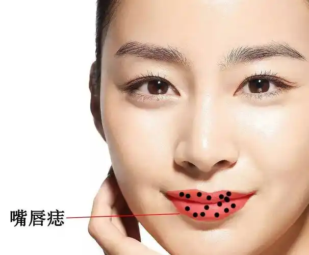 影响婚姻痣:嘴唇有痣下嘴唇代表妻子,上嘴唇代表丈夫,下嘴唇有痣代表