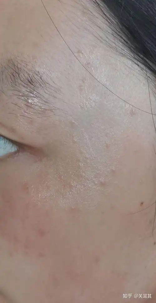 扁平疣爆发中 - 知乎