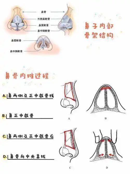 鼻骨内推可以增高鼻梁术后还是有点宽