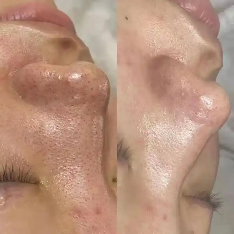 深层清洁#痘痘黑头粉刺拜拜 #解决任何皮肤问题 #变美就是这 - 抖音