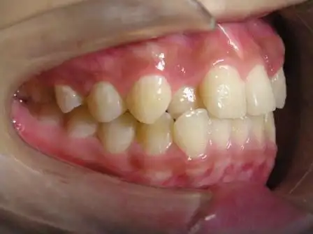 腭向错位的上侧切牙矫正过程组图原创