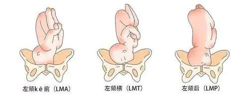 对胎位的描述loa  roa  lsa是? - 知乎