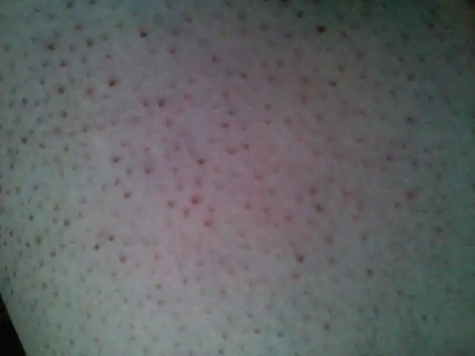 这些黑头在皮肤上,皮肤也不痛不痒(只是很难看),我