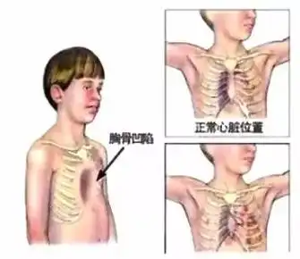 鸡胸形成原因有许多及时治疗与改善为关键