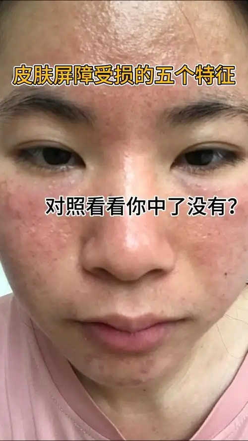 皮肤屏障受损的五个特征,你中了哪个?