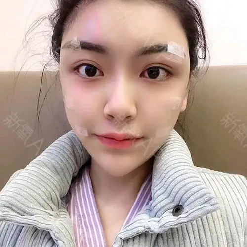 自体脂肪面部填充