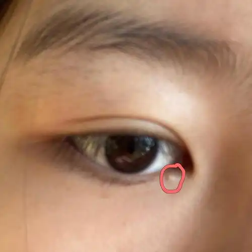 请问姐妹们,下眼睑这里长了一个有点明显的白白的东西,这是啥啊该怎么