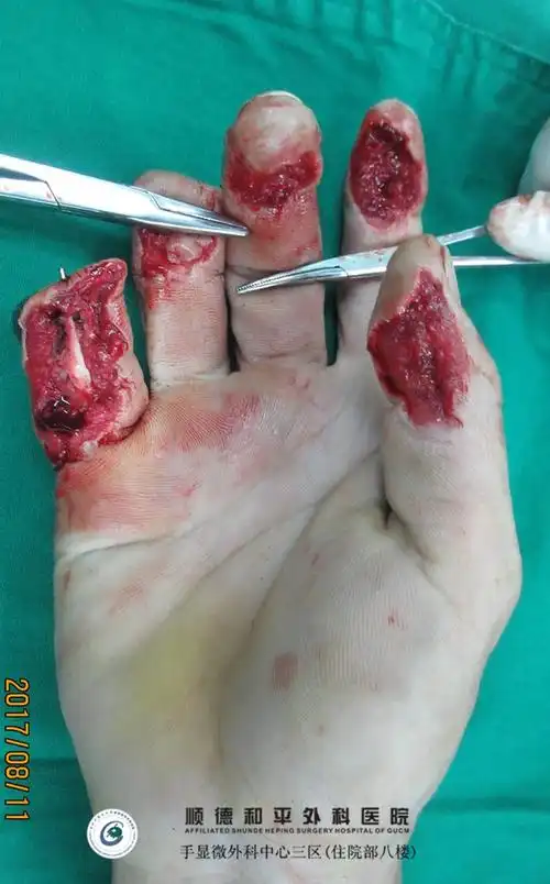 右手1-5指切割伤-皮耐克 静脉皮瓣修复