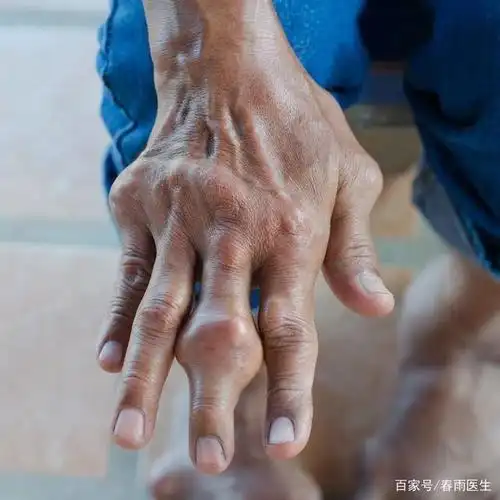 (痛风患者的手指/图源:123rf)
