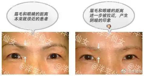 工匠的技术眼睑下垂的治疗