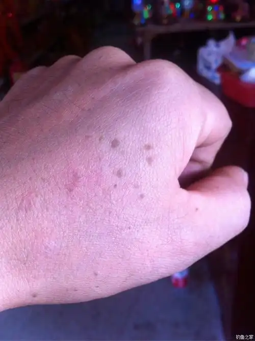最近发现手背上的鱼鳞越来越多了