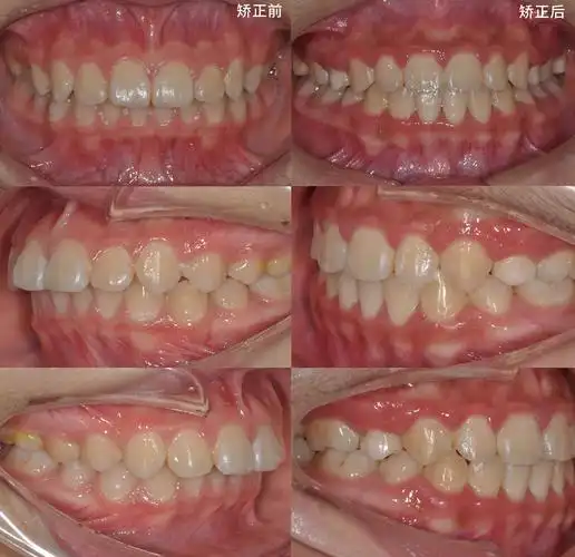 嘴突少女变女神,牙齿矫正比你想象的更加神奇