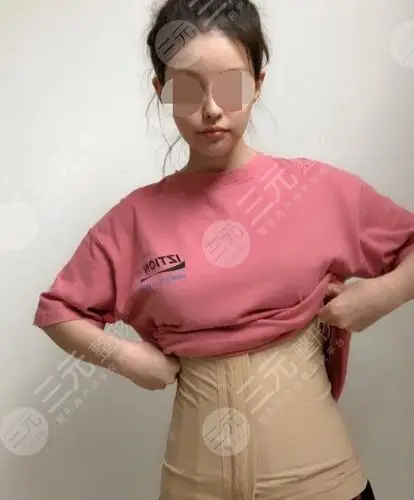 附腰腹吸脂前后对比图