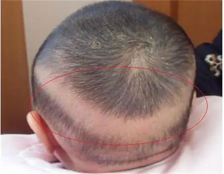 冬季户外活动减少如何判断宝宝是否缺乏维生素d