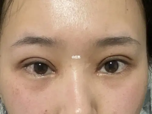 全切双眼皮 开眼角 第15天_双眼皮_开眼角_全切双眼皮_双眼皮手术_割