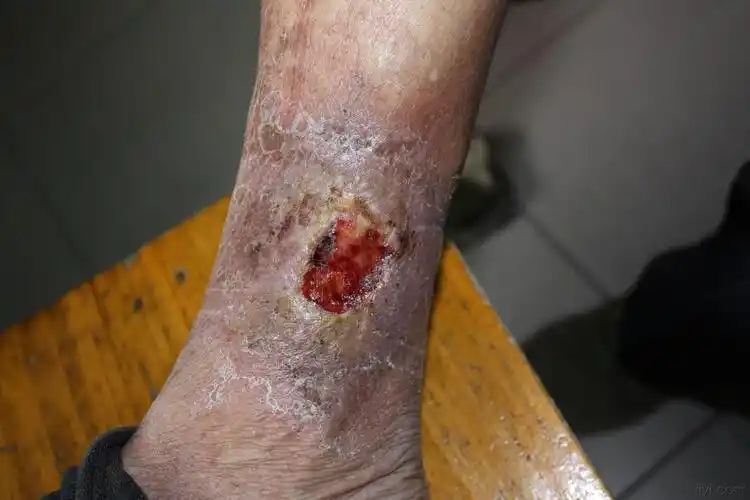 下肢溃疡请教中医高手