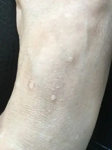 请问这种白斑是什么?不痛不痒,有些能摸到凸出感有些摸不到,看着像