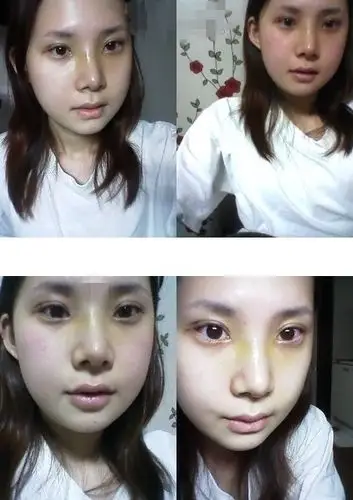 面部综合整形手术前后对比照片分享和恢复经历