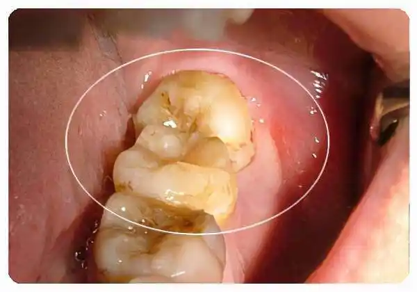 智齿不拔有什么危害我的智齿拔了脸型变了