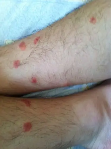 我以前吃虾不过敏的,我前几天吃了几天虾结果就过敏了(我也不清楚是不