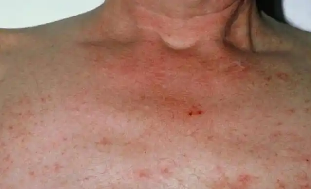 46岁男子肝癌离世,医生:一年前就有症状,但没当回事