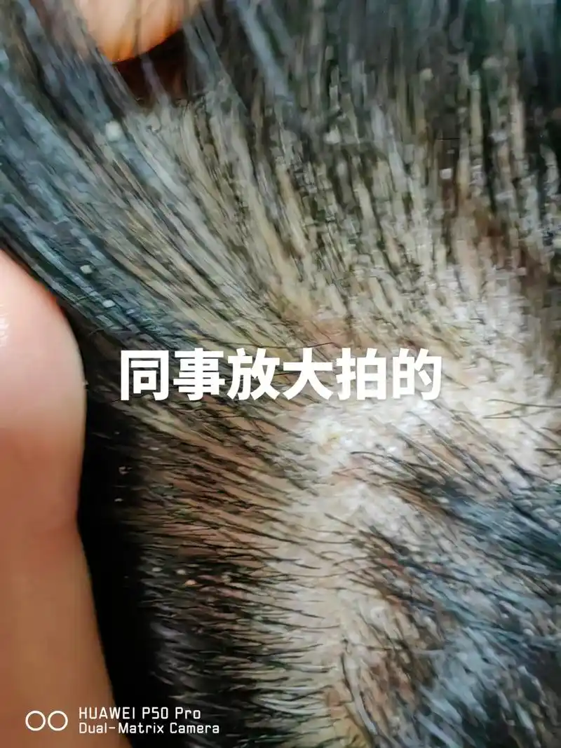 分享一下治好头痒的方法,头痒到现在 - 抖音