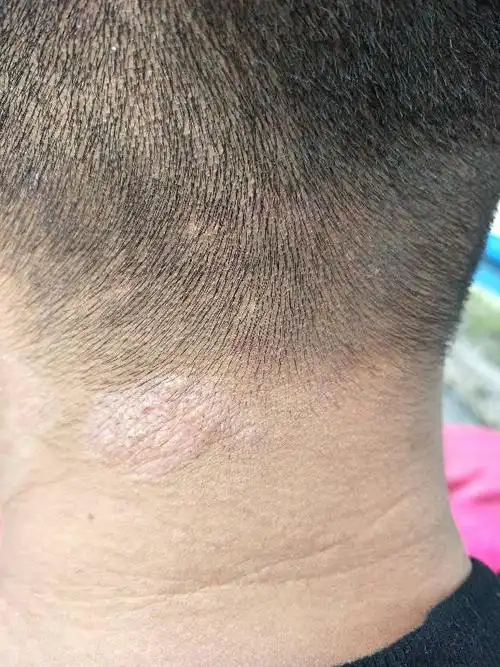 脖子上长了一块像癣一样的东西,之前胳膊上也有,好几个月了到底怎么