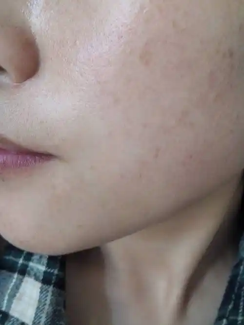 我22岁,皮肤暗黄,还有斑.从17岁长斑现在越来越多.是不是可以吃vc.ve?