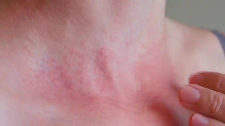 长春肤康医院浅谈过敏性皮炎有哪些症状应如何治疗与护理