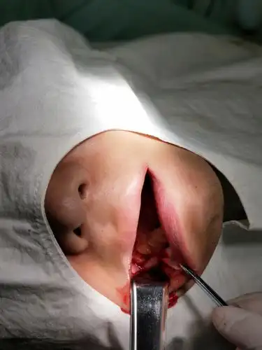 手术中,48牙暴露.