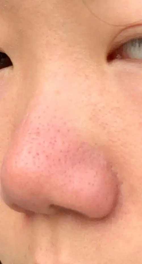 毛孔粗大第一人,已绝望