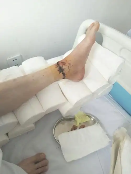 这伤口的黑是怎么回事