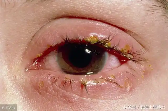 眼睛经常流泪是什么原因?