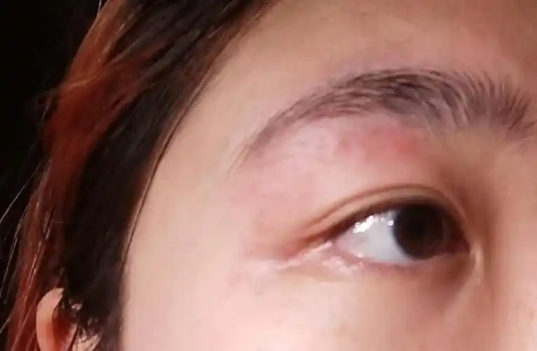 姐妹们 我的眼睛上面长了这种红色的小东西 痒痒的 是什么啊